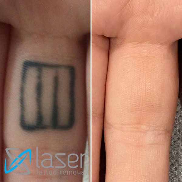 Tattoos Laser Removal in Akron OH